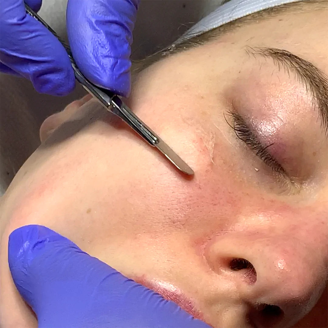 Dermaplaning
